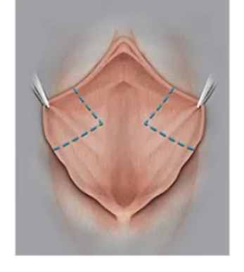 Labiaplasty, labia minora reduction by wedge method