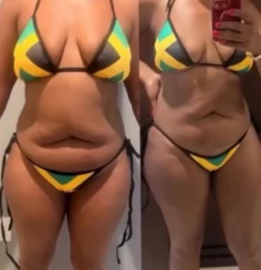 Before and after weight loss transformation in a bikini.