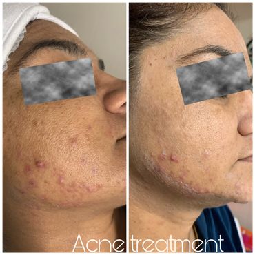 Acne Treatment with DPC technology