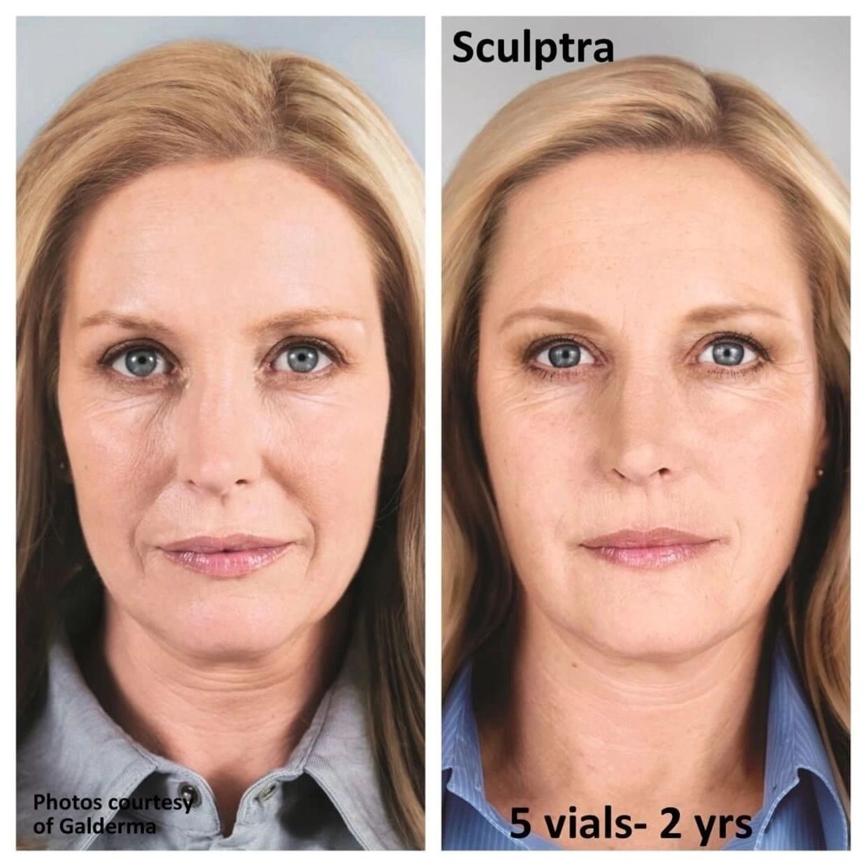 SCULPTRA THE LIQUID GOLD In Anti Aging Therapy