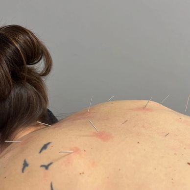Person receiving acupuncture treatment on their back with visible needles and red marks.