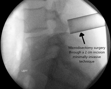 Private Spine Surgery Canada