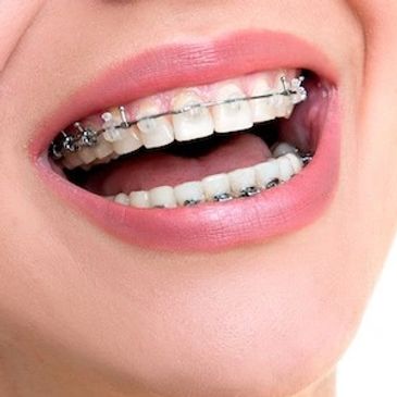 Ortodonti, Diş Teli, Şeffaf Plak Orthero Bayrampaşa İstanbul