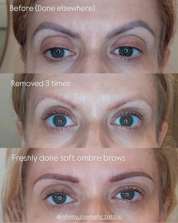 Browfix goldcosst the best eyebrowtattoo gold oast eyebrow tattoo removal near me removery browundo