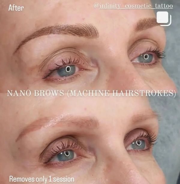 Browfix goldcosst the best eyebrowtattoo gold oast eyebrow tattoo removal near me removery browundo