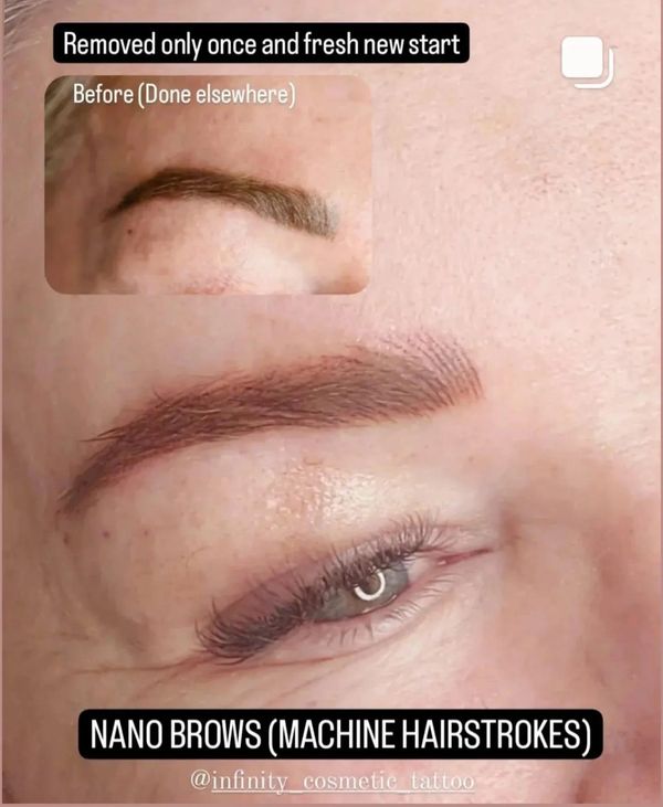 Browfix goldcosst the best eyebrowtattoo gold oast eyebrow tattoo removal near me removery browundo