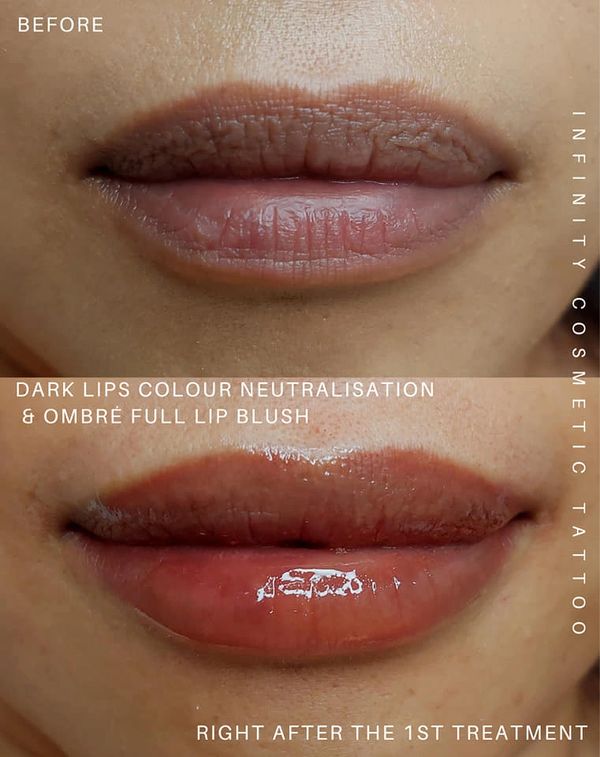 Dark lip correction Gold Coast
Lip color correction Gold Coast
dark lip neutralization Gold Coast