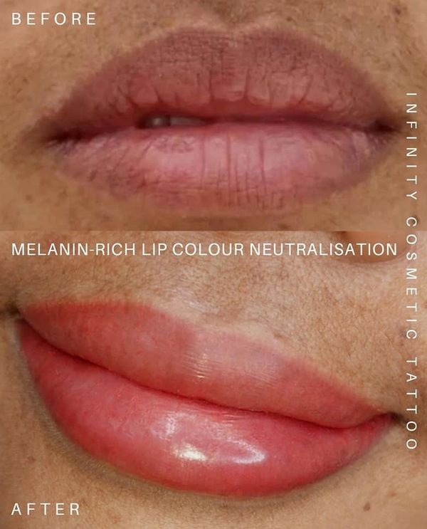 Dark lip correction Gold Coast
Lip color correction Gold Coast
dark lip neutralization Gold Coast