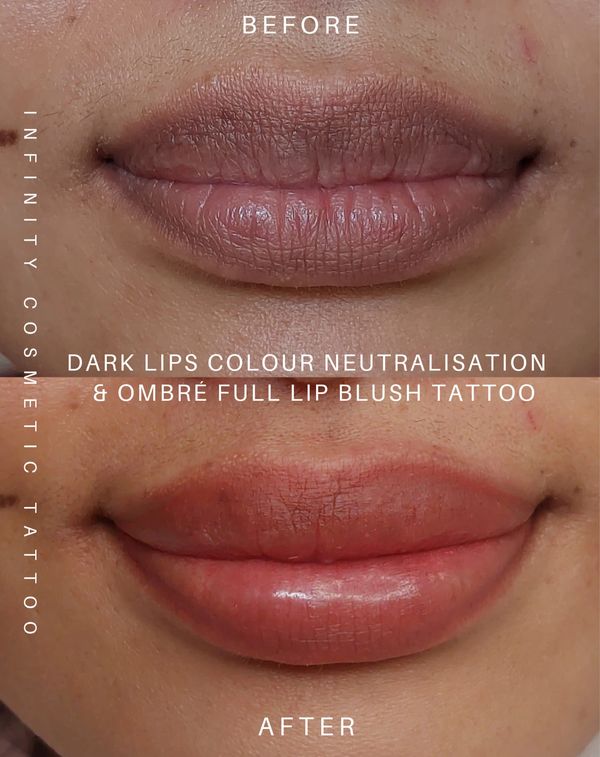 dark lip correction robina
dark lip neutralisation robina
dark lip blush tattoo robina