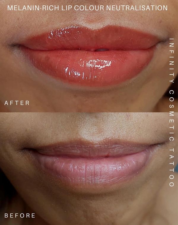 Dark lip correction Gold Coast
Lip color correction Gold Coast
dark lip neutralization Gold Coast