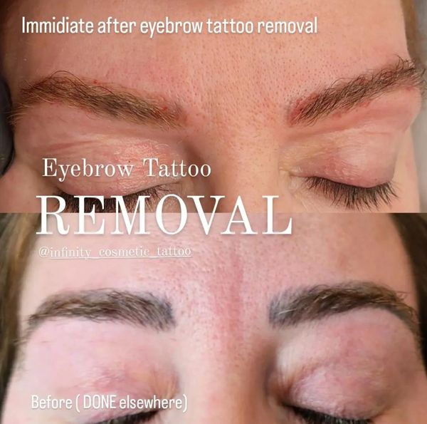 Eyebrow tattoo removal near me
Eyebrow tattoo removal gold coast
Microblading removal gold coast 