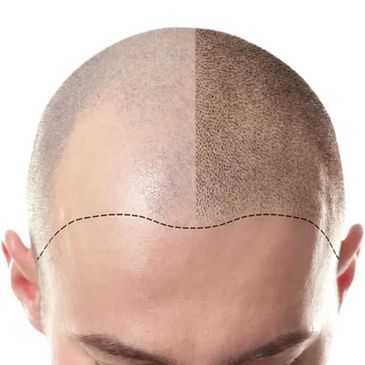 scalp micropigmentation gold coast
head tattoo gold coast
hair loss tattoo gold coast