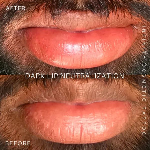 Dark lip correction Gold Coast
Lip color correction Gold Coast
Lip pigmentation neutralization Gold
