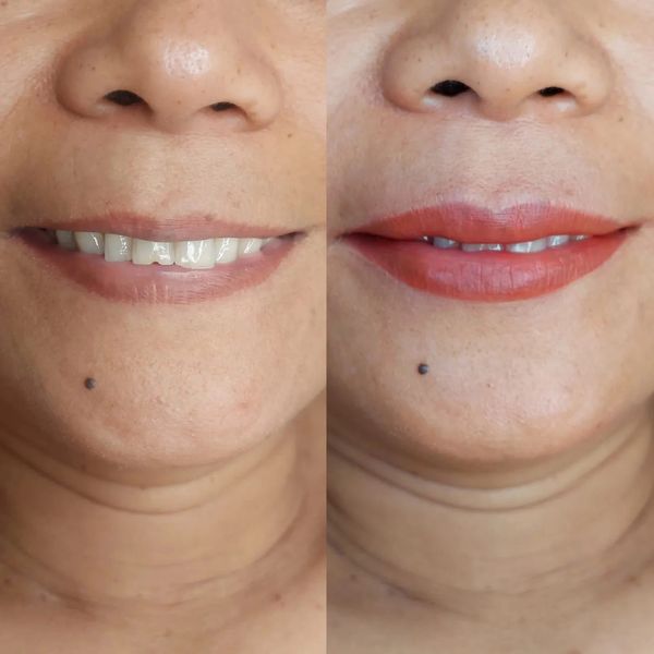 Dark lip correction Gold Coast
Lip color correction Gold Coast
dark lip neutralization Gold Coast