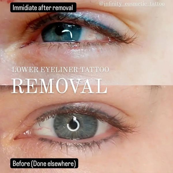 eyeliner tattoo removal gold coast 
eyeliner tattoo removal Brisbane 
eyeliner tattoo removery