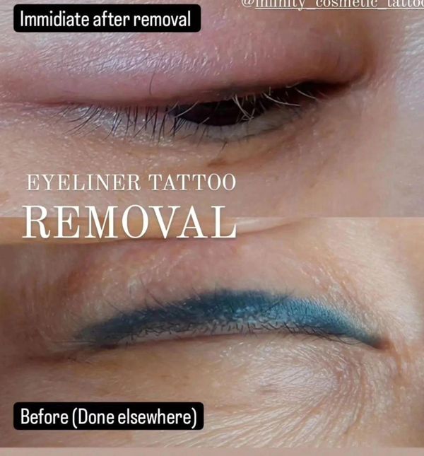 eyeliner tattoo removal gold coast 
eyeliner tattoo removal Brisbane 
eyeliner tattoo removery