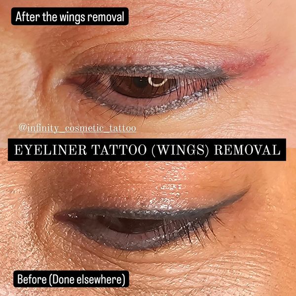 eyeliner tattoo removal gold coast 
eyeliner tattoo removal Brisbane 
eyeliner tattoo removery