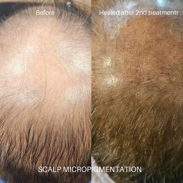 Hair Loss Solution Gold Coast
Scalp Pigmentation Clinic
Baldness Tattoo Gold Coast
smp near me