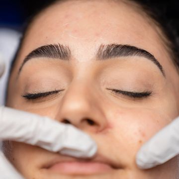 Extractions facial