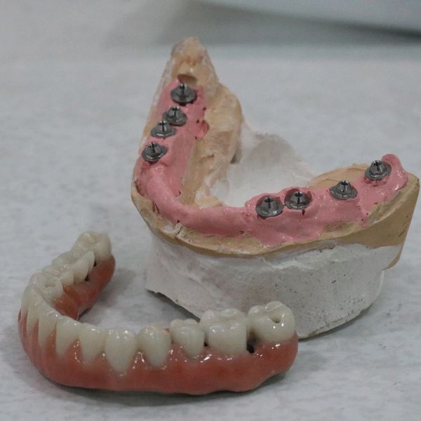 All on X Dental Implant