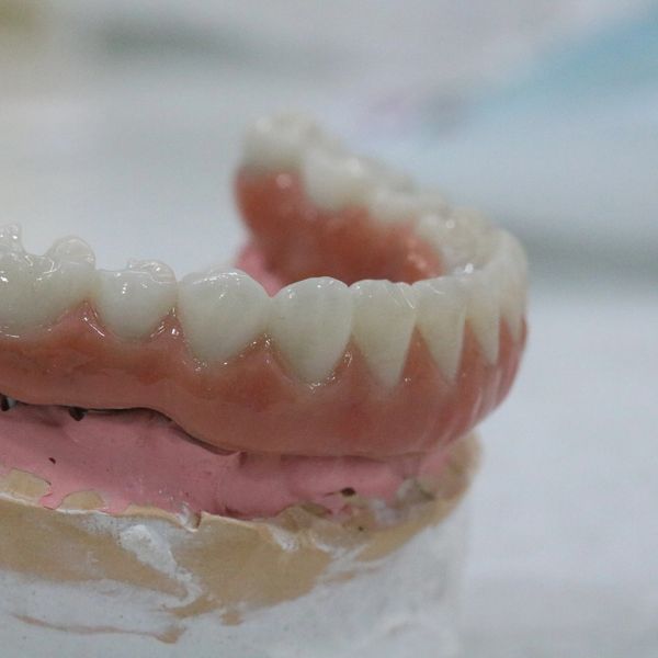 All on X Dental Implants Titanium frame retained zirconia bridge.