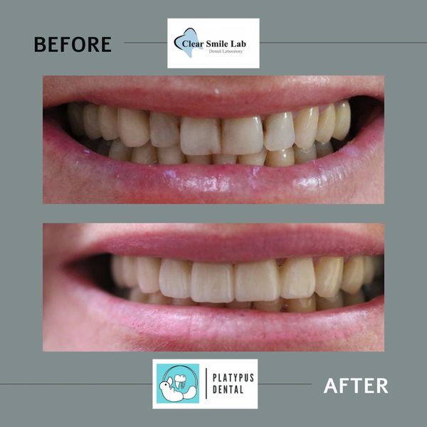 Dental Crowns before and after