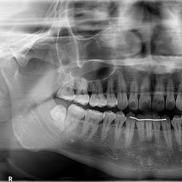 OPG radiograph