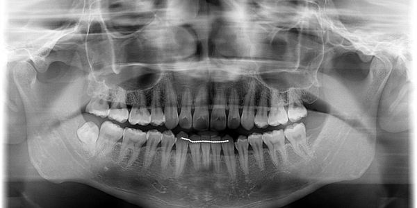 Wisdom teeth extraction at Bald Hills Dentist Platypus Dental