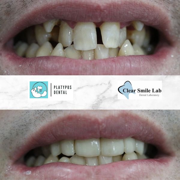 Dental Crowns before and after
