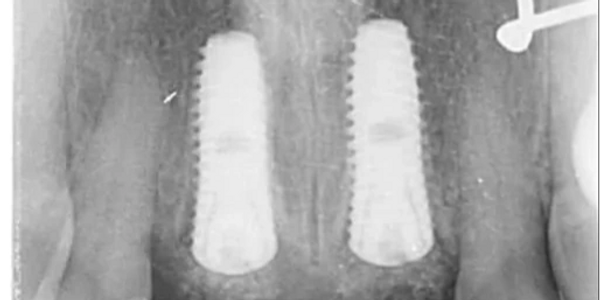 Dental Implants at Bald Hills Dentist Platypus Dental