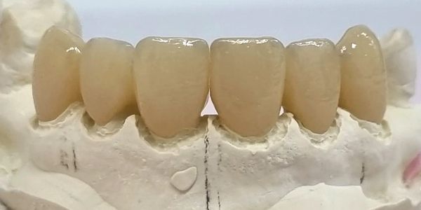 Crowns and Bridges at Bald Hills Dentist Platypus Dental