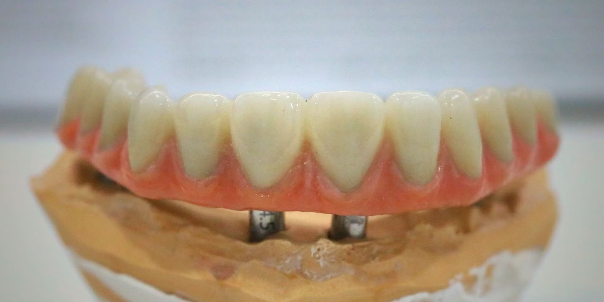 All on 4 dental implant bridge