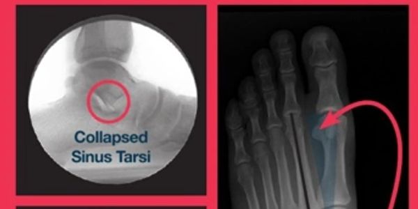 Feet 'N Beyond  Foot x-ray showing abnormal alignment of the foot, collapsed sinus tarsi noted