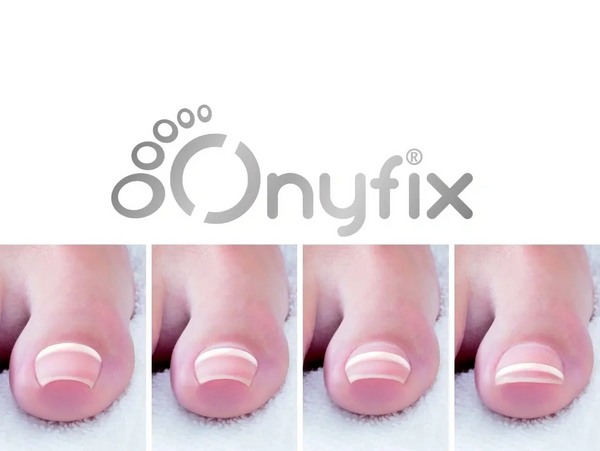 FNB | ONYFIX SOLUTION  SURGERY-FREE INGROWN TOENAIL TREATMENT