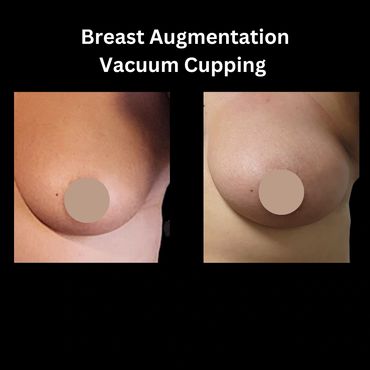 Noninvasive Vacuum Breast Lift