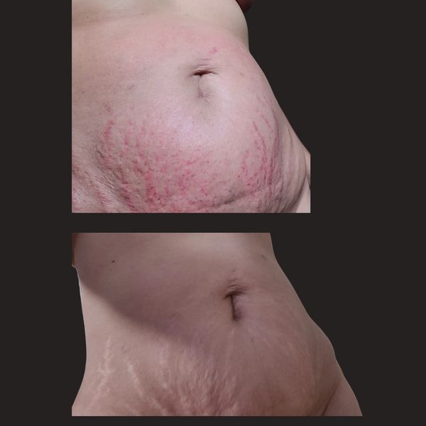 Whole Body Body Sculpting | Before and After Stretch Marks Treatment with Radio Frequency