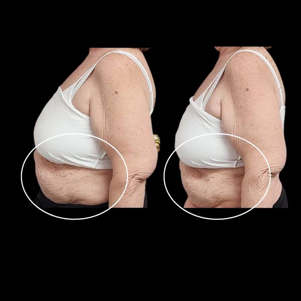 Whole Body Body Sculpting | Before and After Stomach