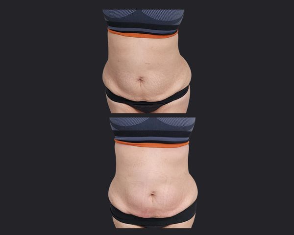 Whole Body Body Sculpting | Before and After Stomach