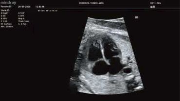 Cerebro fetal FULL HD