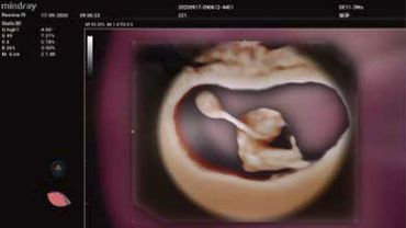 Feto con cordon umbilical