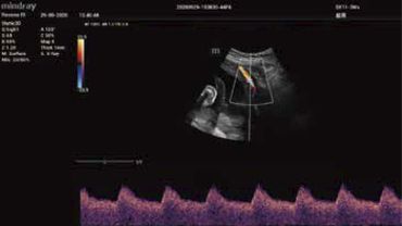 estudios especializados en arteria uterina