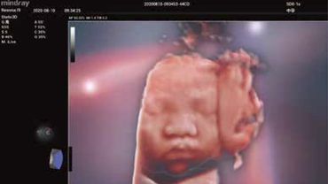 Ultrasonido con resolucion de imágenes en alta calidad