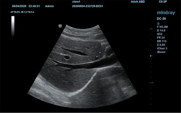 Hígado imagenes d ealta calidad de estudios de higado excelente escala de grises