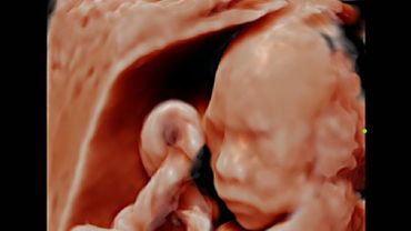 Estudio Fetal (23 sem.)