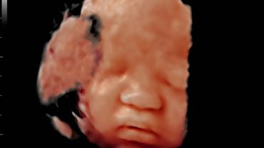 Estudio Fetal (32 sem.)