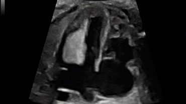 Corazón Fetal afectado por esclerosis múltiple