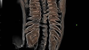 Columna Fetal con Hyaline