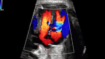 Esclerosis Múltiple con Color