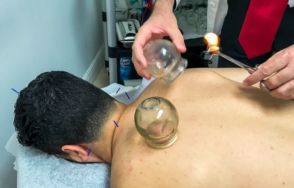 Foto que muestra uno de nuestros tratamientos ventosas cupping.