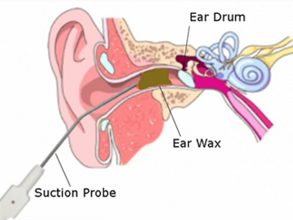 Ear microsuction, irrigation and syringing